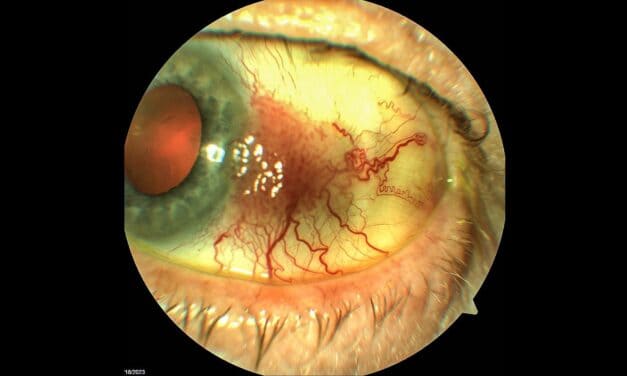 PHOTO ESSAY: “New” Red Eye – A Case of Conjunctival Intraepithelial Neoplasia