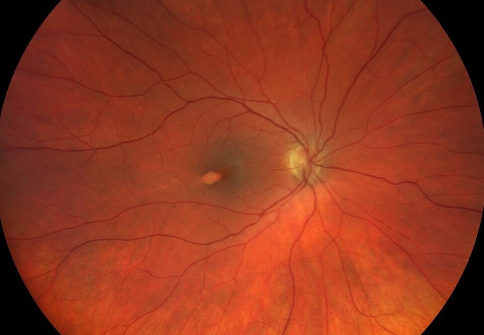 Torpedo Maculopathy