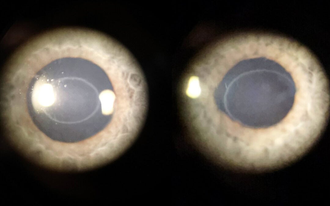 Bilateral Idiopathic Corneal Ring Opacity (Ascher Ring)
