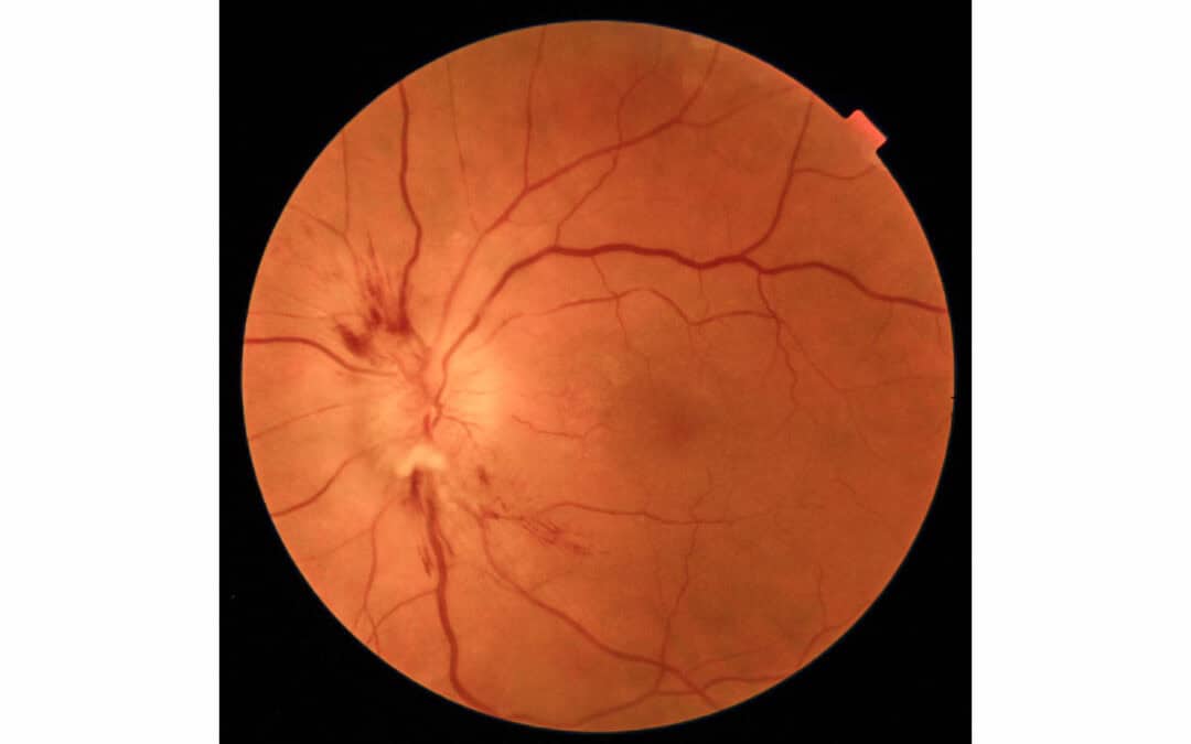 Overtreated Hypertension Results in Sequential Nonarteritic Ischemic Optic Neuropathy