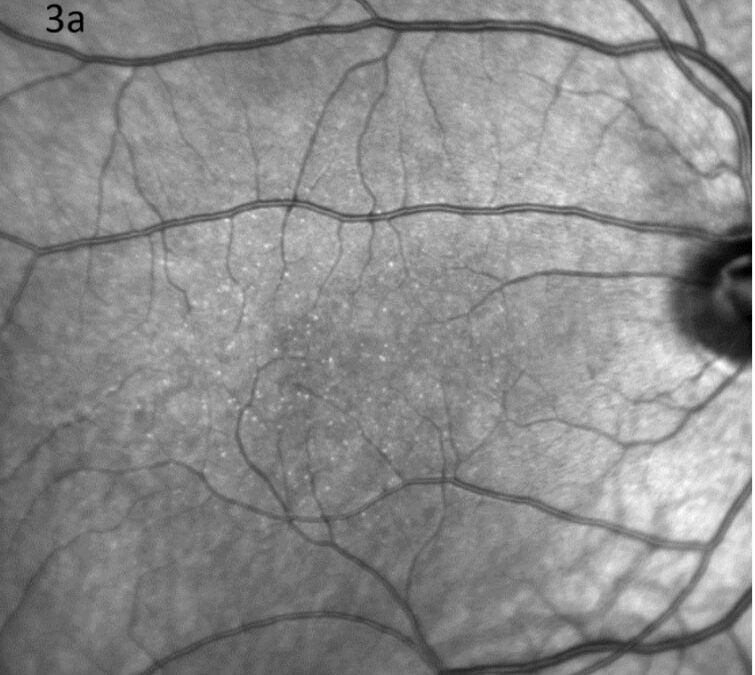 Benign Yellow Dot Maculopathy