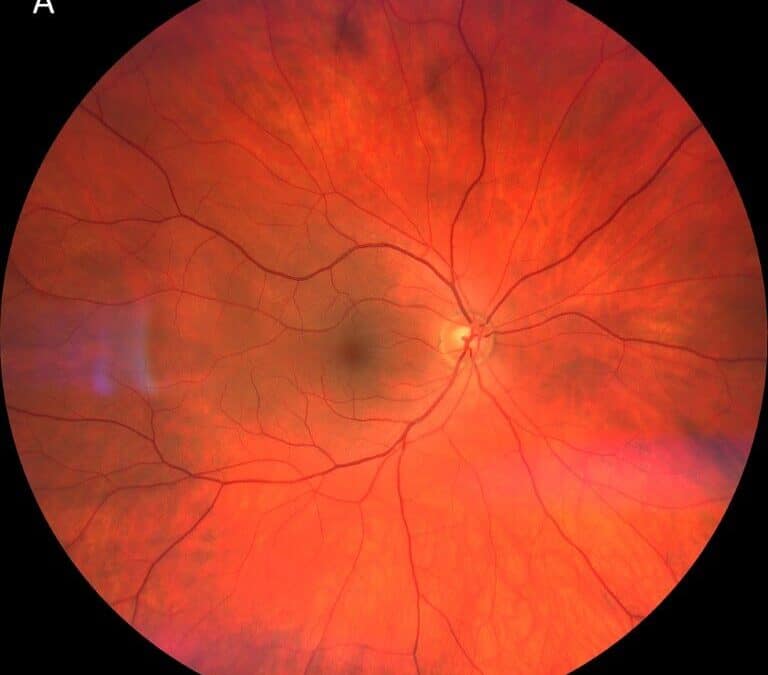 Behcet’s Disease Flares Up BADS: A Bilateral Anterior Diffuse Scleritis Case Report