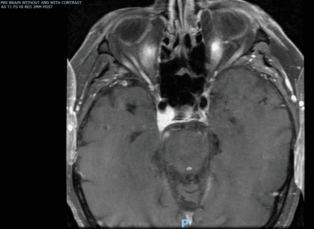 fig 2 mri brain axial t1 fs hi res 3 mm post contrast(1) (medium)