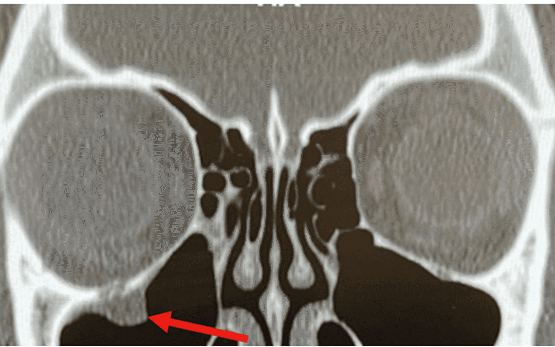 The “Not So Easy” Orbital Floor Fracture Case