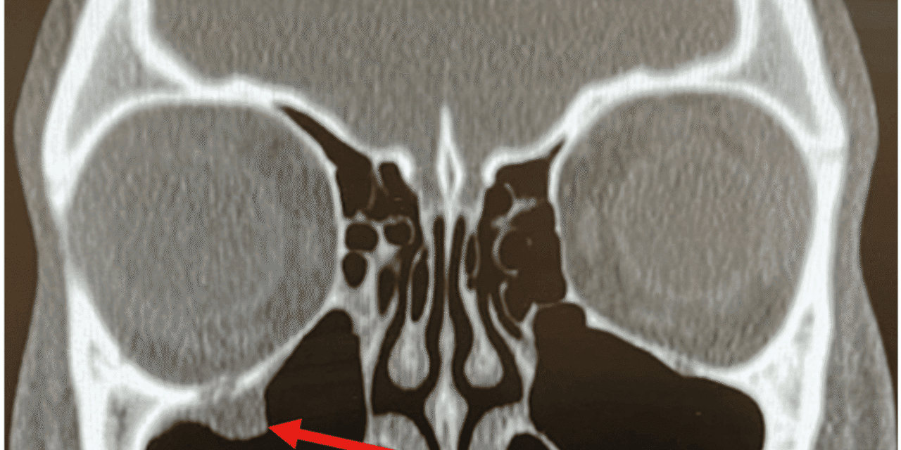 The “Not So Easy” Orbital Floor Fracture Case