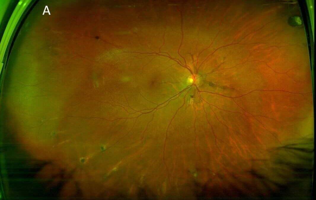 Pseudoxanthoma Elasticum and Angioid Streaks