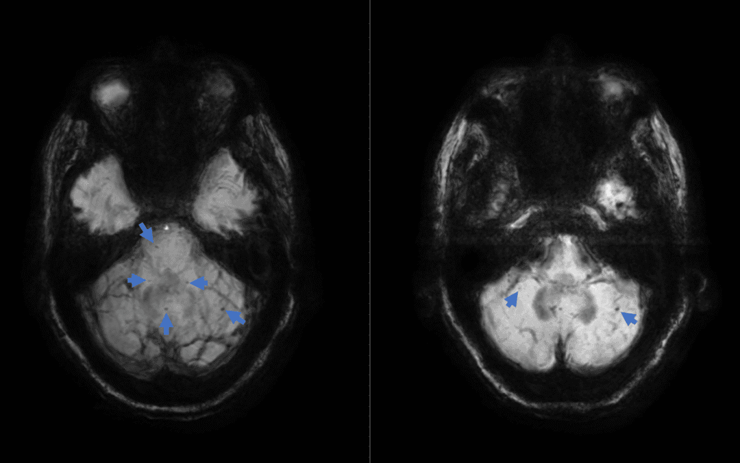 Ocular Tilt Reaction Associated with Infratentorial Microhemorrhages and Siderosis
