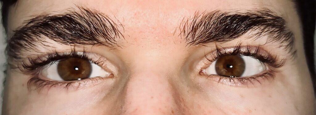botox figure 2(1)