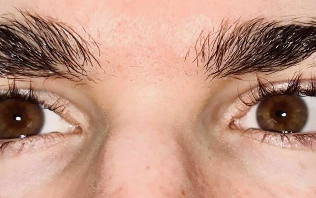 A Case Series of Ophthalmic Manifestations of Facial Botox Injections