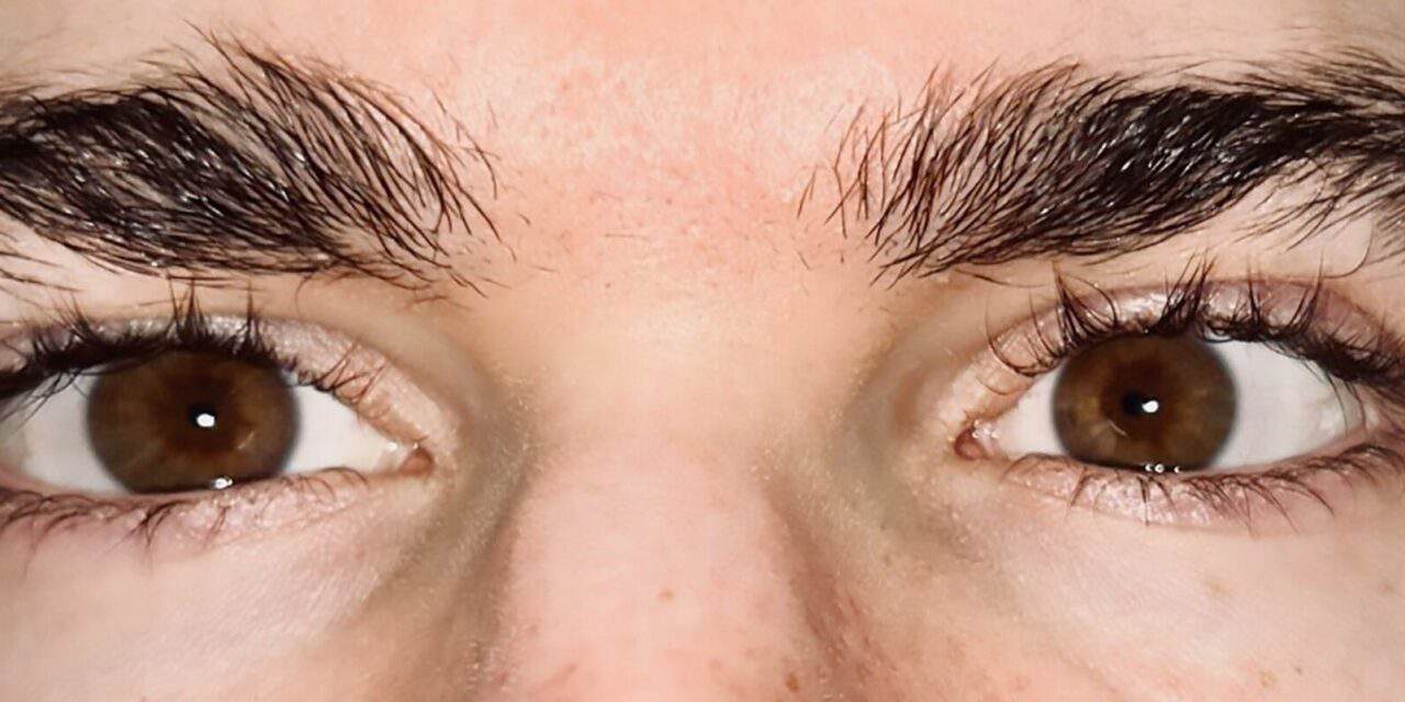 A Case Series of Ophthalmic Manifestations of Facial Botox Injections