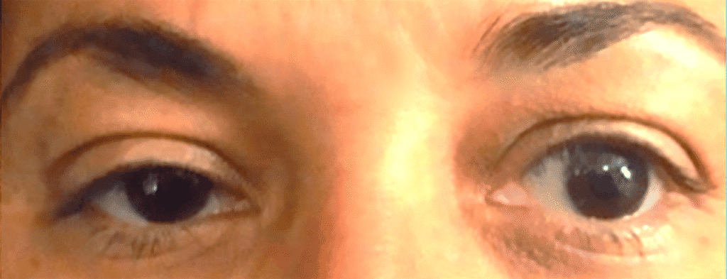 botox figure 3(1)