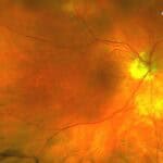 Navigating Choroidal Folds: A Comprehensive Approach for the Primary Care Optometrist