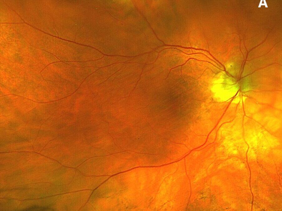 Navigating Choroidal Folds: A Comprehensive Approach for the Primary Care Optometrist