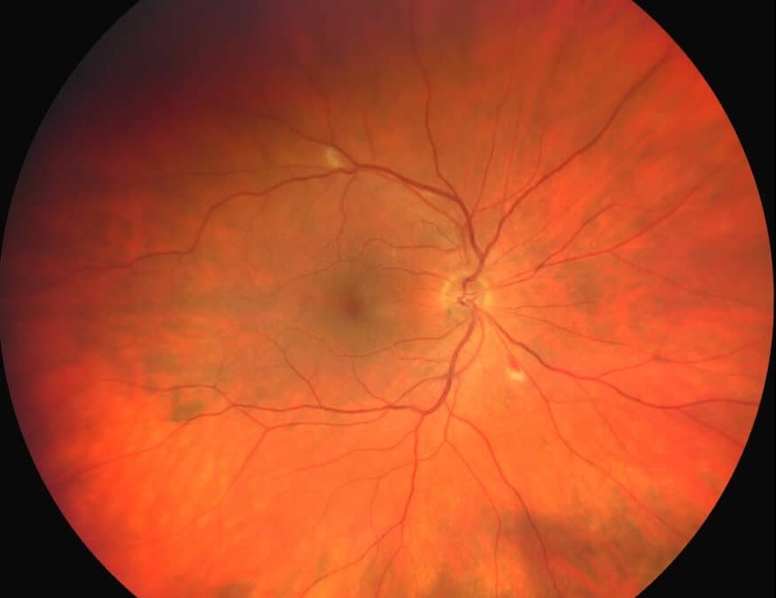 Anemic Retinopathy Secondary to Babesiosis Infection