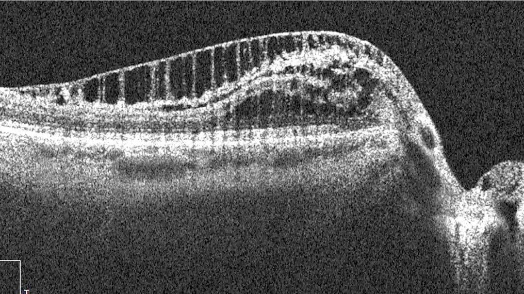Paradoxical Progression in Nerve Fiber Analysis from Peripapillary Retinoschisis