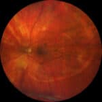 Photo Essay – A Spiral Illusion: An Atypical Presentation of Schlaegel Lines