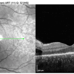 Bilateral Optic Nerve Edema Leading to the Diagnosis of Ocular Syphilis