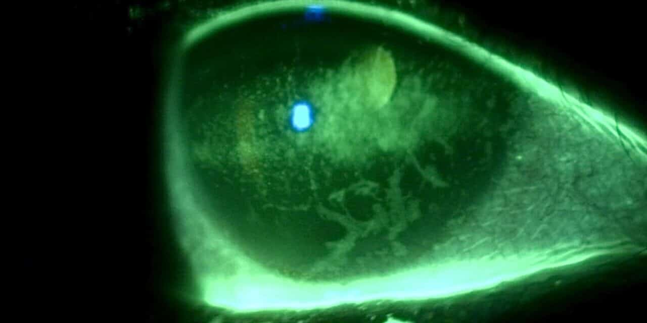 Ocular Sequelae of Trigeminal Neuralgia Following Complicated Oral Surgery: A Case Report