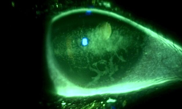 Ocular Sequelae of Trigeminal Neuralgia Following Complicated Oral Surgery: A Case Report