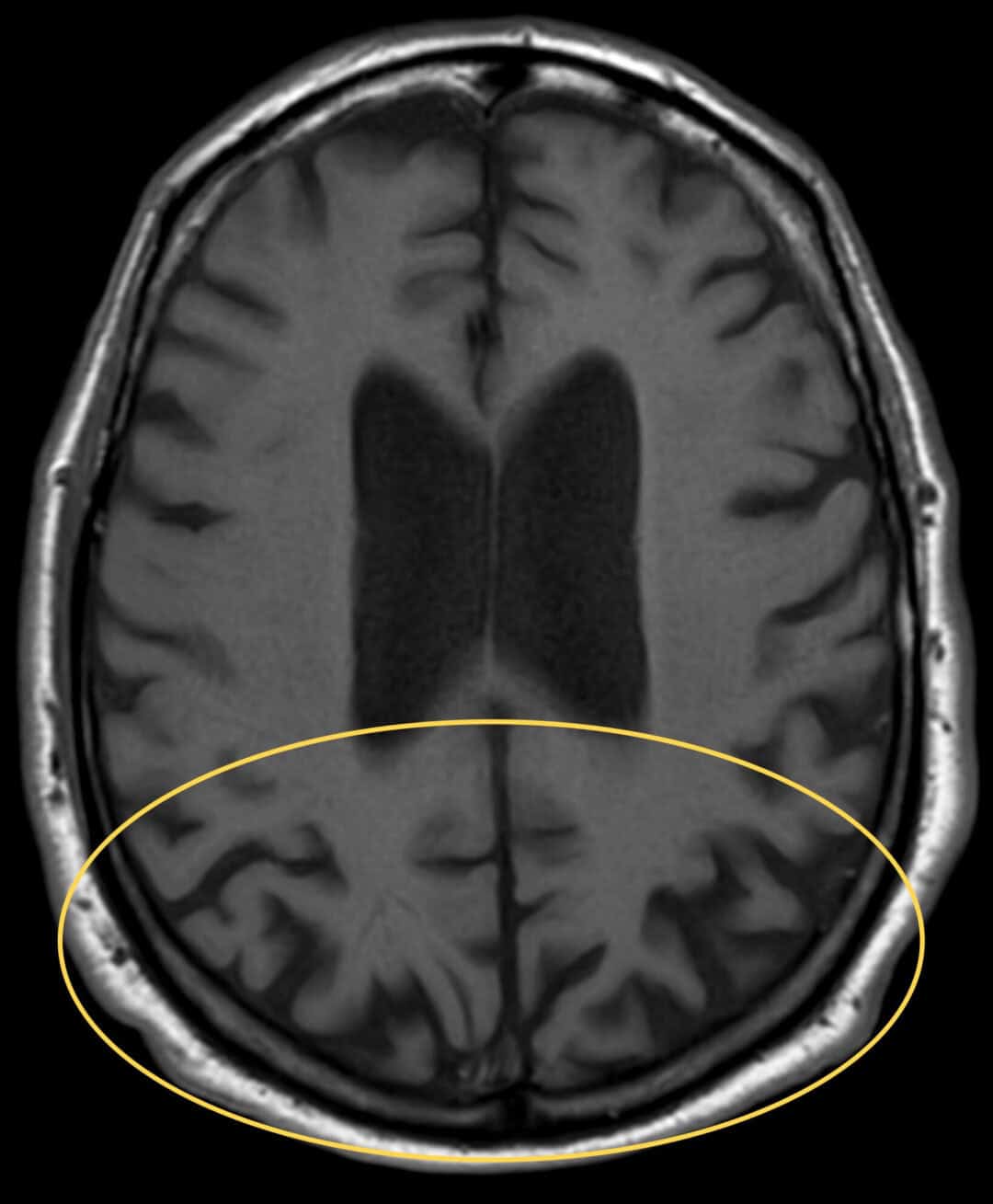 Diagnosis and Management of Posterior Cortical Atrophy from an Eye Care ...