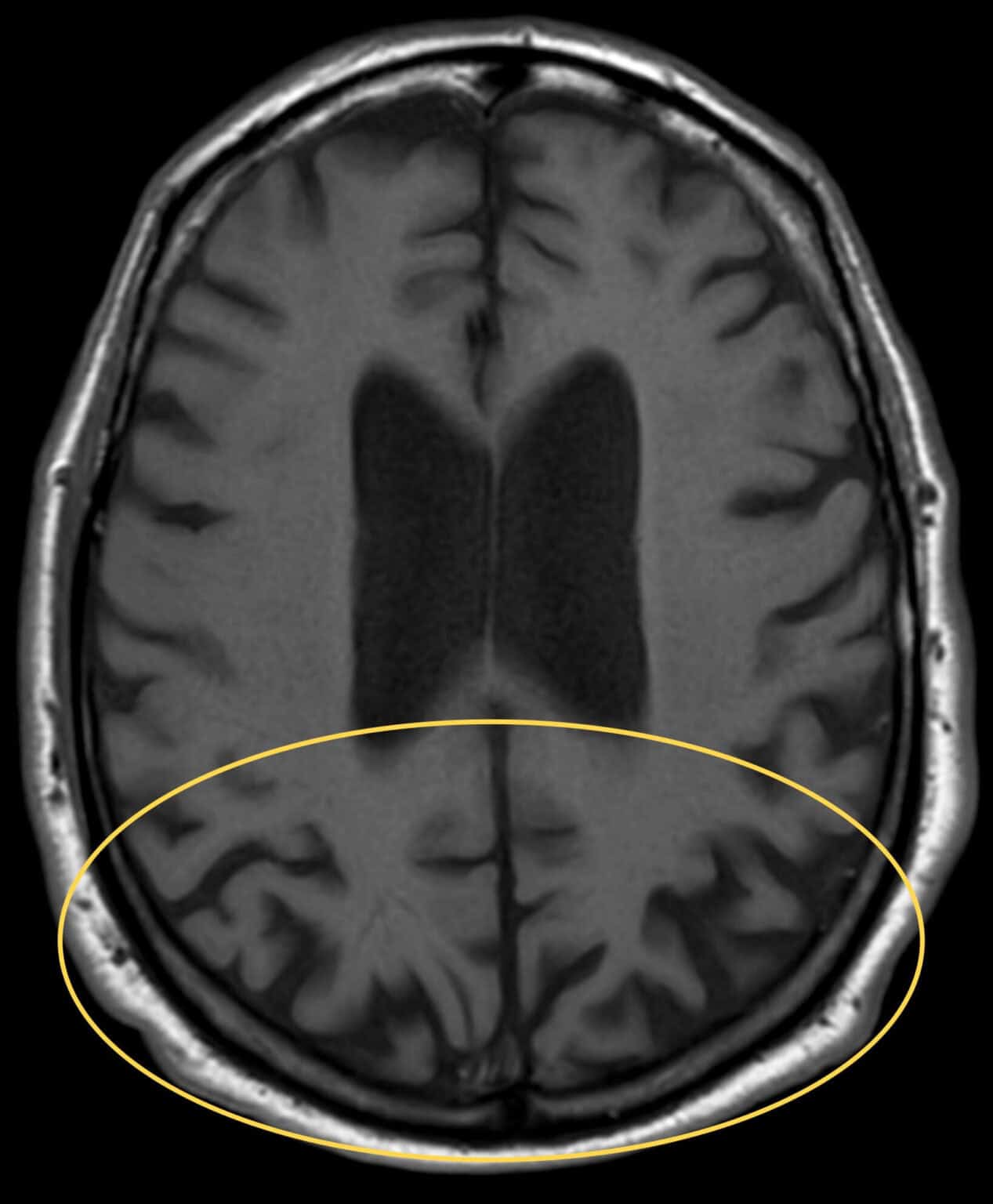 Diagnosis and Management of Posterior Cortical Atrophy from an Eye Care ...