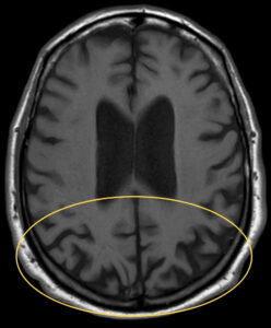 Diagnosis and Management of Posterior Cortical Atrophy from an Eye Care ...