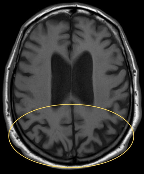 Diagnosis and Management of Posterior Cortical Atrophy from an Eye Care ...