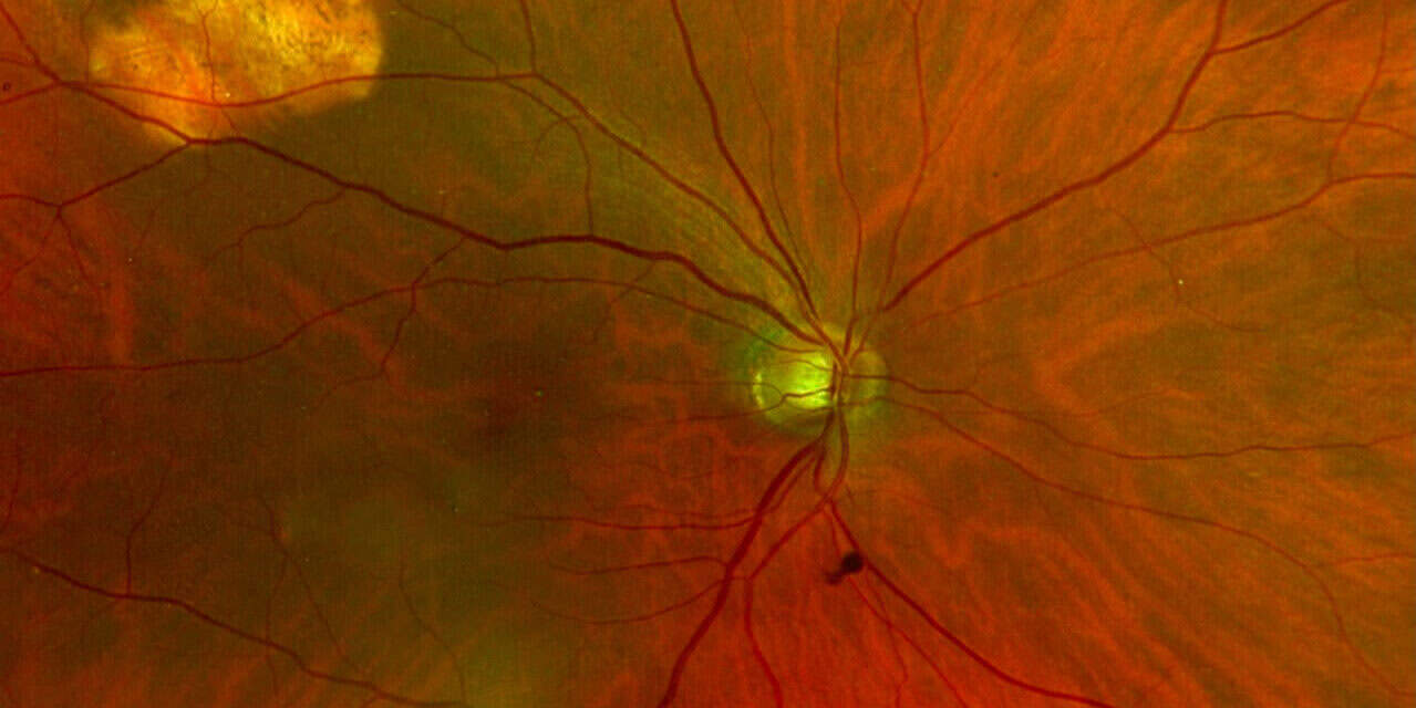 Photo Essay: Sclerochoroidal Calcifications