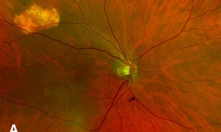 Photo Essay: Sclerochoroidal Calcifications