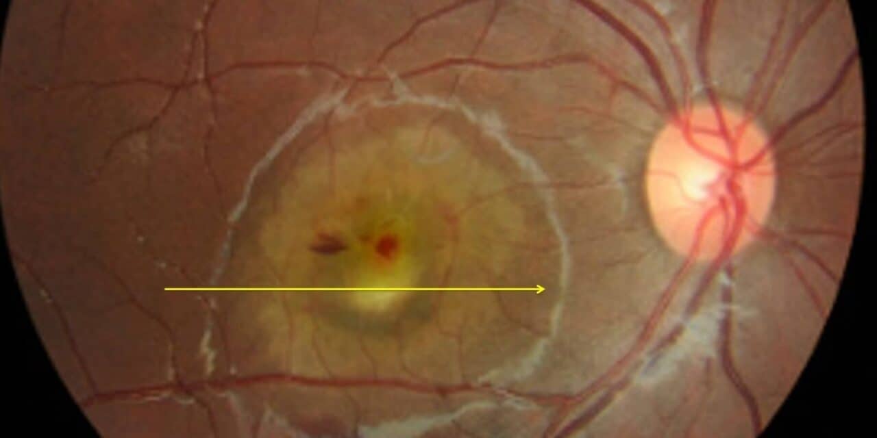 Case Report: Genetically Confirmed Best Vitelliform Macular Dystrophy and Butterfly Pattern Dystrophy in the Same Family