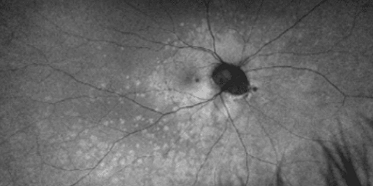 A Case of Multiple Evanescent White Dot Syndrome in a Myopic Male