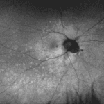 A Case of Multiple Evanescent White Dot Syndrome in a Myopic Male