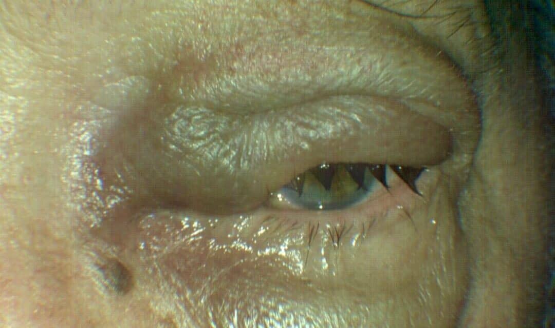 Lymphoma Masquerading as a Hordeolum
