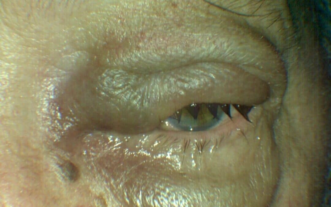 Lymphoma Masquerading as a Hordeolum
