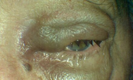 Lymphoma Masquerading as a Hordeolum