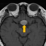 A Case Of Pituitary Apoplexy With Cavernous Sinus Involvement