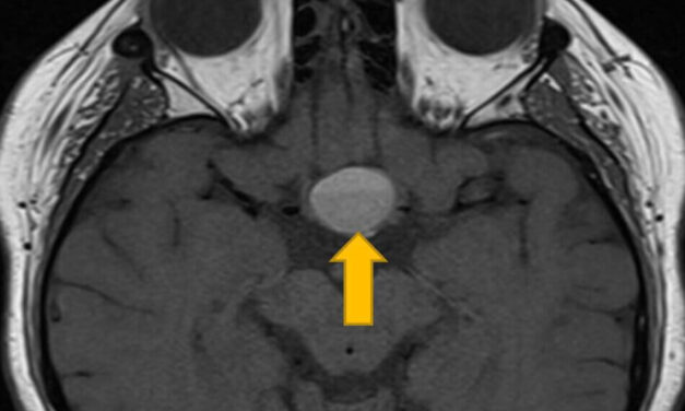 A Case Of Pituitary Apoplexy With Cavernous Sinus Involvement