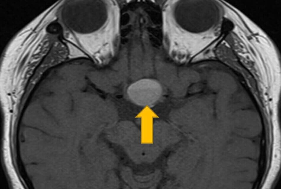 A Case Of Pituitary Apoplexy With Cavernous Sinus Involvement