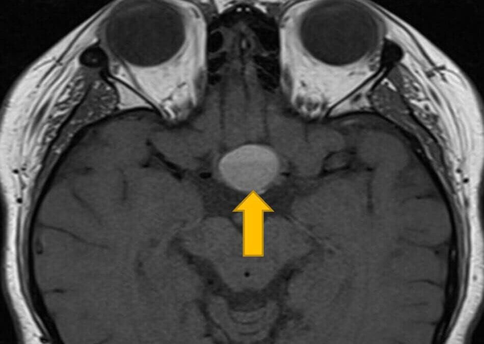 A Case Of Pituitary Apoplexy With Cavernous Sinus Involvement