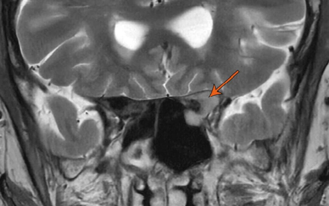 When Prostate Cancer Reaches the Orbit: A Case Report