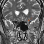 When Prostate Cancer Reaches the Orbit: A Case Report