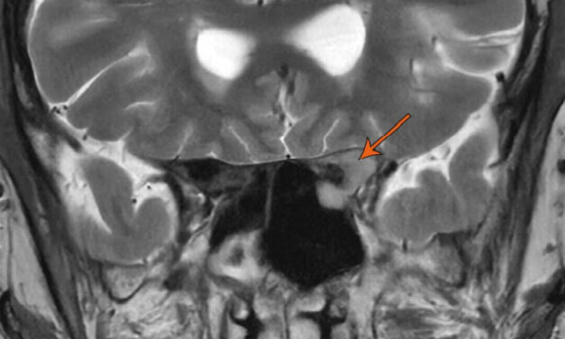 When Prostate Cancer Reaches the Orbit: A Case Report