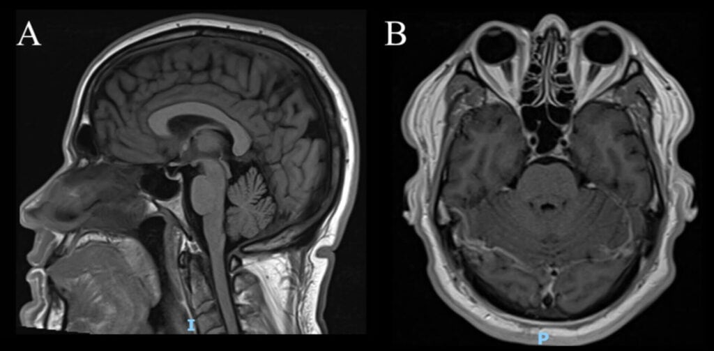 fig 2 mri brain disc edema case (large) (1)