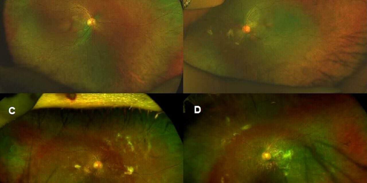 Kearns-Sayre Syndrome with a Finding of Unique Subretinal Hyperreflective Deposits: A Case Report