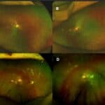 Kearns-Sayre Syndrome with a Finding of Unique Subretinal Hyperreflective Deposits: A Case Report
