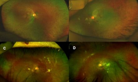 Kearns-Sayre Syndrome with a Finding of Unique Subretinal Hyperreflective Deposits: A Case Report