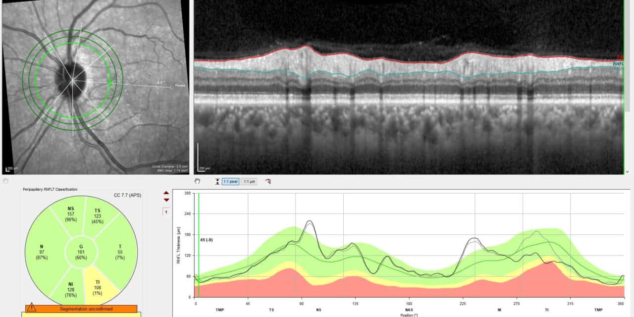 A Case of Incidental Diagnosis of Subclinical Sectoral Non-Arteritic Anterior Ischemic Optic Neuropathy in a Glaucoma Suspect