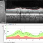 A Case of Incidental Diagnosis of Subclinical Sectoral Non-Arteritic Anterior Ischemic Optic Neuropathy in a Glaucoma Suspect