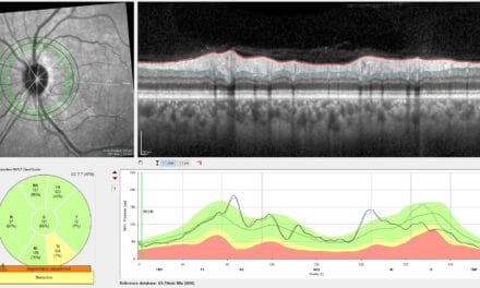 A Case of Incidental Diagnosis of Subclinical Sectoral Non-Arteritic Anterior Ischemic Optic Neuropathy in a Glaucoma Suspect