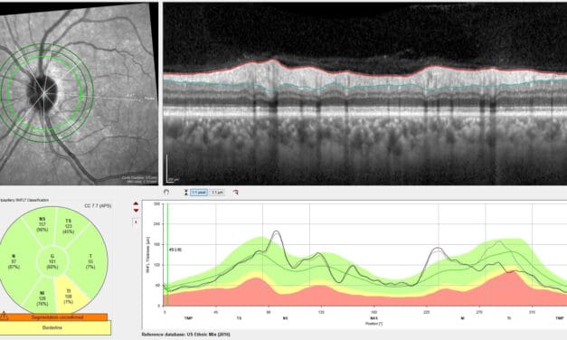 A Case of Incidental Diagnosis of Subclinical Sectoral Non-Arteritic Anterior Ischemic Optic Neuropathy in a Glaucoma Suspect